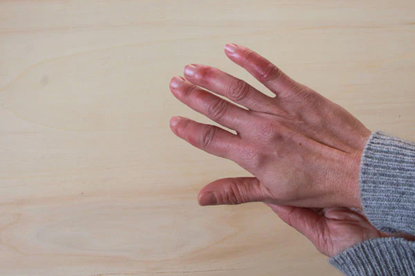 Chilblains
